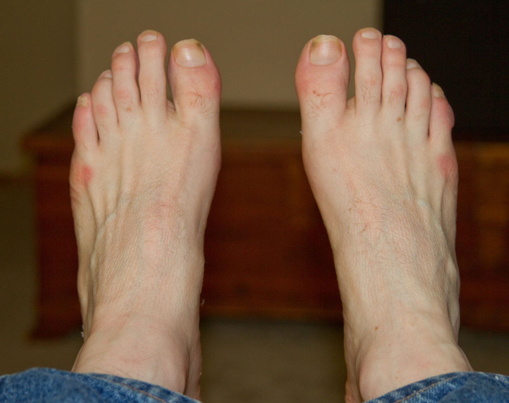 Red Spots On Feet 27